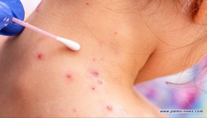 ترقب لإعلان حالة الطوارئ.. "جدري القردة" يثير قلق العالم